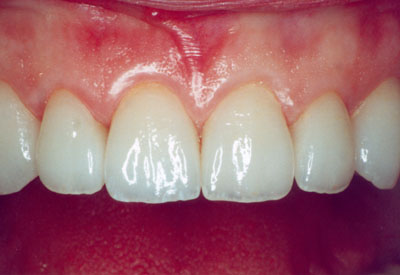 Porcelain Veneers