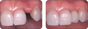 Dental Implants