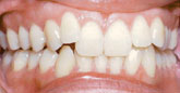 Braces - Orthodontics