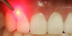 Laser Dentistry
