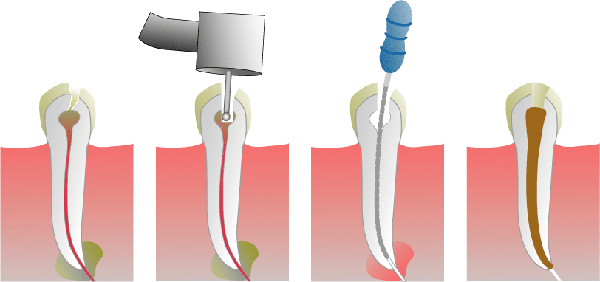 Root Canal Therapy