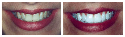Teeth Whitening